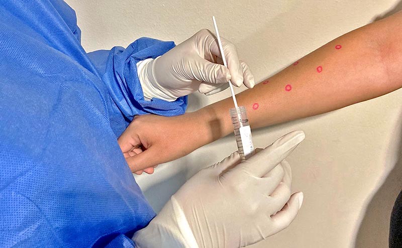 Reporta salud estatal un nuevo caso de viruela símica en BCS